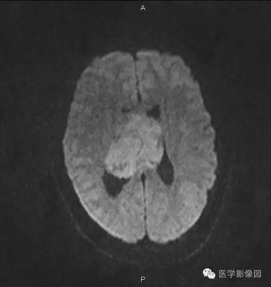 【病例】侧脑室中枢神经细胞瘤1例MR影像表现