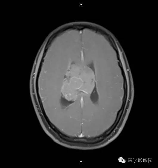 【病例】侧脑室中枢神经细胞瘤1例MR影像表现