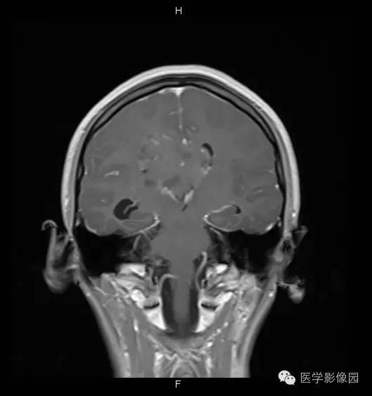 【病例】侧脑室中枢神经细胞瘤1例MR影像表现