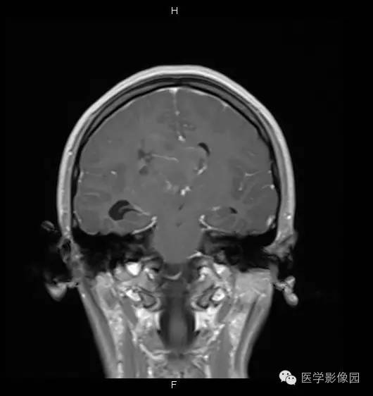 【病例】侧脑室中枢神经细胞瘤1例MR影像表现