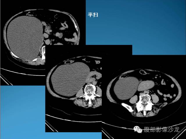 【病例】腹膜后皮样囊肿1例CT影像表现 【病例】腹膜后皮样囊肿1例CT影像表现