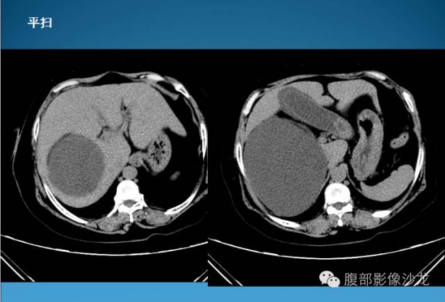【病例】腹膜后皮样囊肿1例CT影像表现 【病例】腹膜后皮样囊肿1例CT影像表现