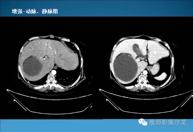 【病例】腹膜后皮样囊肿1例CT影像表现 【病例】腹膜后皮样囊肿1例CT影像表现