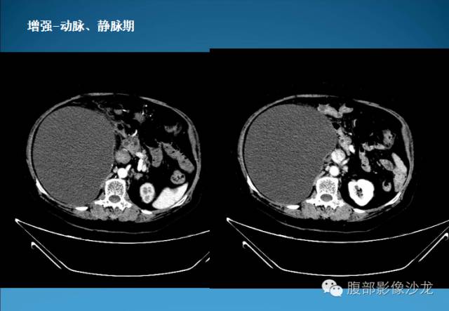 【病例】腹膜后皮样囊肿1例CT影像表现 【病例】腹膜后皮样囊肿1例CT影像表现