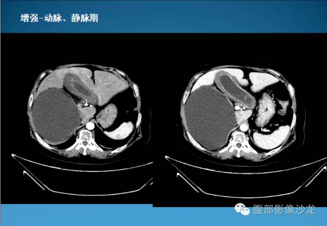 【病例】腹膜后皮样囊肿1例CT影像表现 【病例】腹膜后皮样囊肿1例CT影像表现