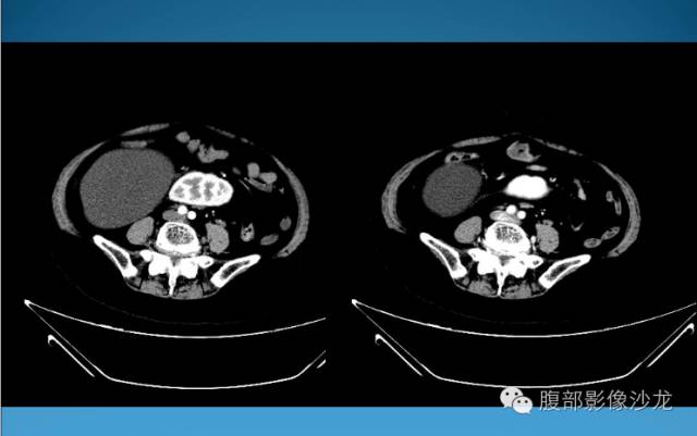 【病例】腹膜后皮样囊肿1例CT影像表现 【病例】腹膜后皮样囊肿1例CT影像表现
