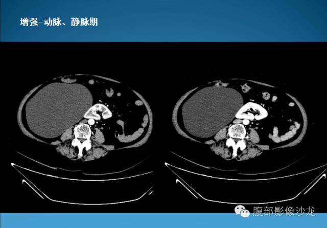 【病例】腹膜后皮样囊肿1例CT影像表现 【病例】腹膜后皮样囊肿1例CT影像表现