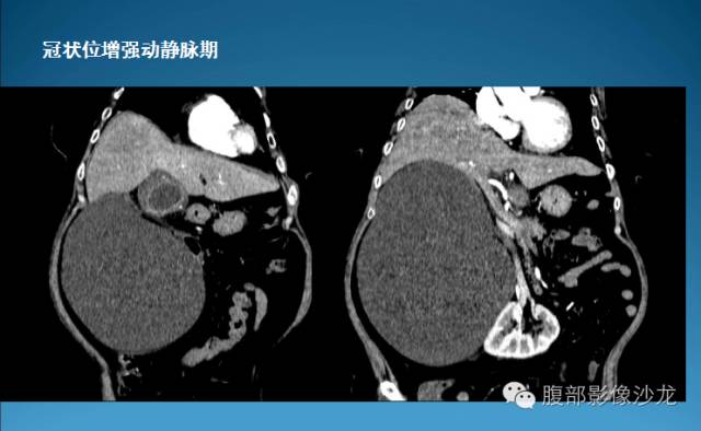 【病例】腹膜后皮样囊肿1例CT影像表现 【病例】腹膜后皮样囊肿1例CT影像表现