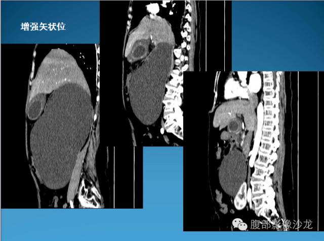 【病例】腹膜后皮样囊肿1例CT影像表现 【病例】腹膜后皮样囊肿1例CT影像表现