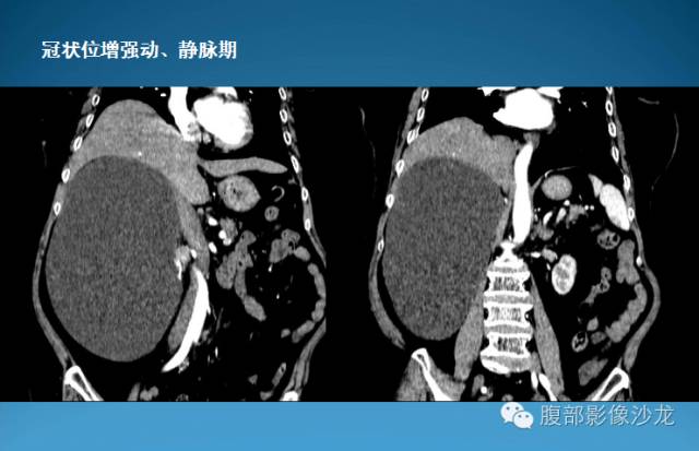 【病例】腹膜后皮样囊肿1例CT影像表现 【病例】腹膜后皮样囊肿1例CT影像表现
