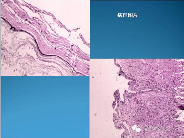 【病例】腹膜后皮样囊肿1例CT影像表现 【病例】腹膜后皮样囊肿1例CT影像表现
