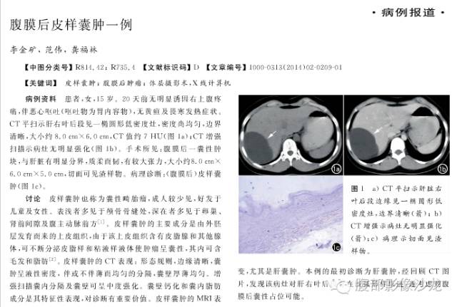 【病例】腹膜后皮样囊肿1例CT影像表现 【病例】腹膜后皮样囊肿1例CT影像表现