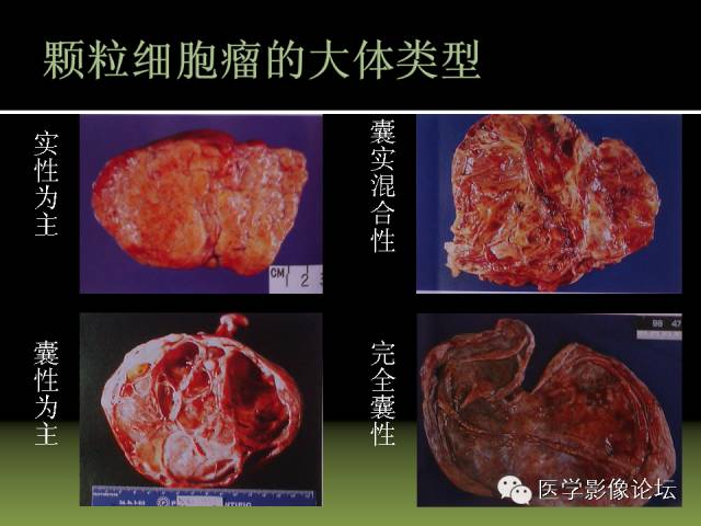 【PPT】卵巢颗粒细胞-间质细胞肿瘤的影像表现 【PPT】卵巢颗粒细胞-间质细胞肿瘤的影像表现