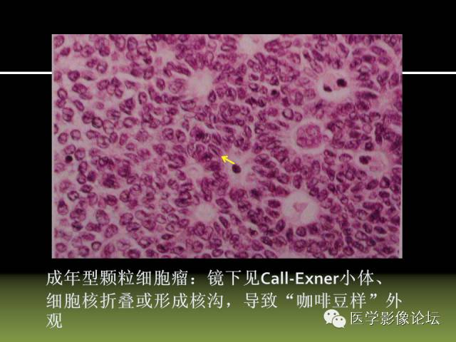 【PPT】卵巢颗粒细胞-间质细胞肿瘤的影像表现 【PPT】卵巢颗粒细胞-间质细胞肿瘤的影像表现