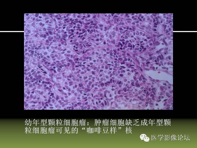 【PPT】卵巢颗粒细胞-间质细胞肿瘤的影像表现 【PPT】卵巢颗粒细胞-间质细胞肿瘤的影像表现