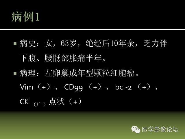 【PPT】卵巢颗粒细胞-间质细胞肿瘤的影像表现 【PPT】卵巢颗粒细胞-间质细胞肿瘤的影像表现