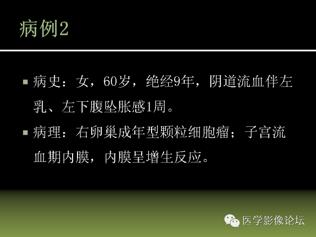 【PPT】卵巢颗粒细胞-间质细胞肿瘤的影像表现 【PPT】卵巢颗粒细胞-间质细胞肿瘤的影像表现