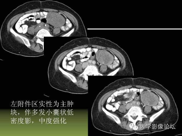 【PPT】卵巢颗粒细胞-间质细胞肿瘤的影像表现 【PPT】卵巢颗粒细胞-间质细胞肿瘤的影像表现