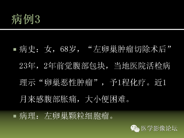 【PPT】卵巢颗粒细胞-间质细胞肿瘤的影像表现 【PPT】卵巢颗粒细胞-间质细胞肿瘤的影像表现