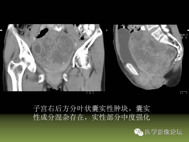 【PPT】卵巢颗粒细胞-间质细胞肿瘤的影像表现 【PPT】卵巢颗粒细胞-间质细胞肿瘤的影像表现