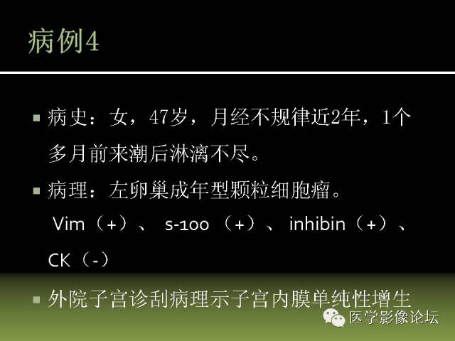 【PPT】卵巢颗粒细胞-间质细胞肿瘤的影像表现 【PPT】卵巢颗粒细胞-间质细胞肿瘤的影像表现