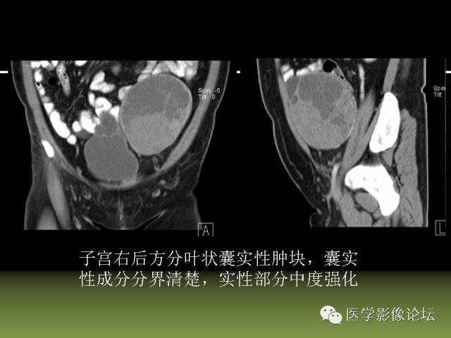 【PPT】卵巢颗粒细胞-间质细胞肿瘤的影像表现 【PPT】卵巢颗粒细胞-间质细胞肿瘤的影像表现