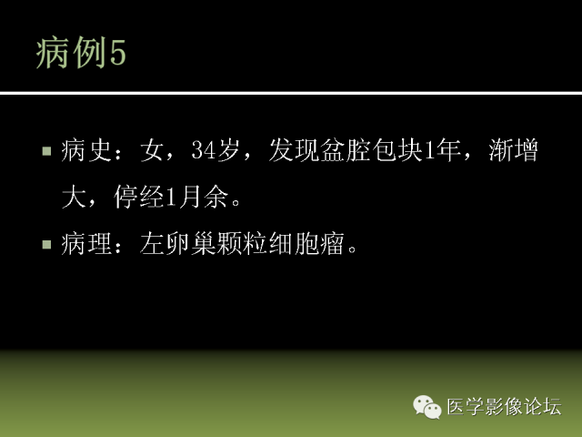【PPT】卵巢颗粒细胞-间质细胞肿瘤的影像表现 【PPT】卵巢颗粒细胞-间质细胞肿瘤的影像表现