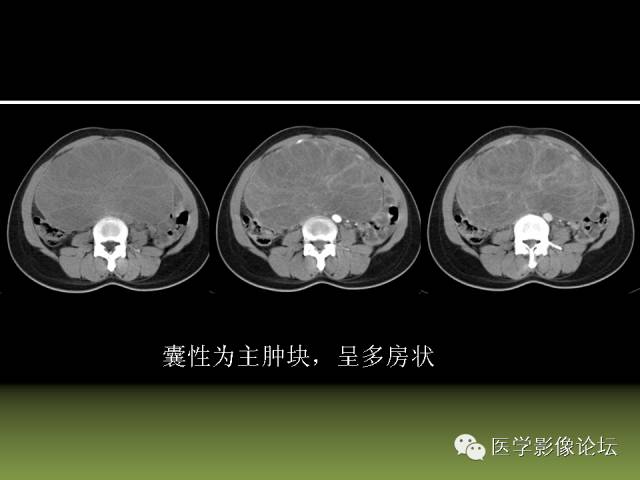 【PPT】卵巢颗粒细胞-间质细胞肿瘤的影像表现 【PPT】卵巢颗粒细胞-间质细胞肿瘤的影像表现