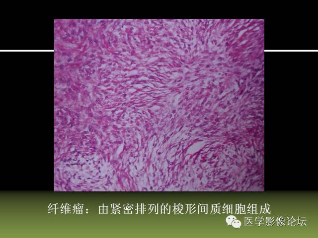 【PPT】卵巢颗粒细胞-间质细胞肿瘤的影像表现 【PPT】卵巢颗粒细胞-间质细胞肿瘤的影像表现