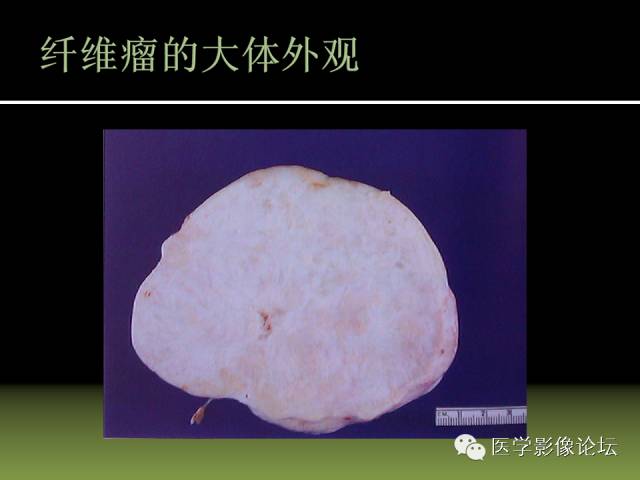 【PPT】卵巢颗粒细胞-间质细胞肿瘤的影像表现 【PPT】卵巢颗粒细胞-间质细胞肿瘤的影像表现