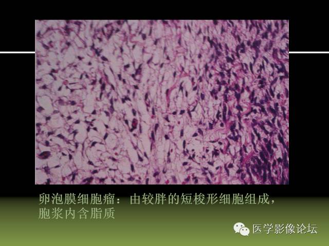 【PPT】卵巢颗粒细胞-间质细胞肿瘤的影像表现 【PPT】卵巢颗粒细胞-间质细胞肿瘤的影像表现