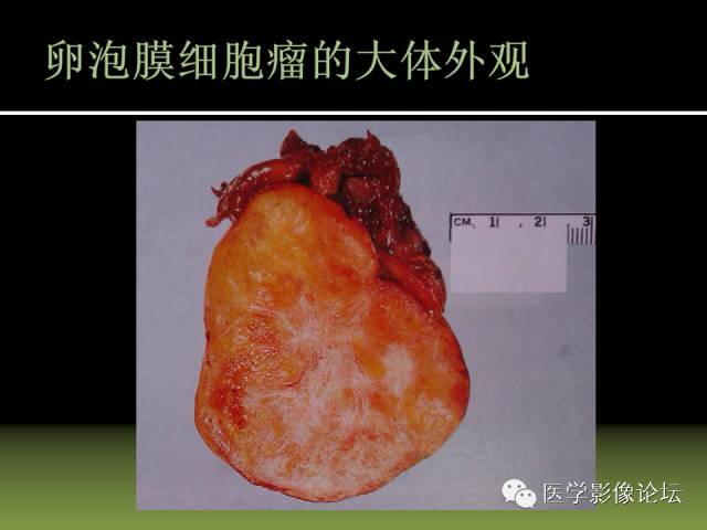 【PPT】卵巢颗粒细胞-间质细胞肿瘤的影像表现 【PPT】卵巢颗粒细胞-间质细胞肿瘤的影像表现