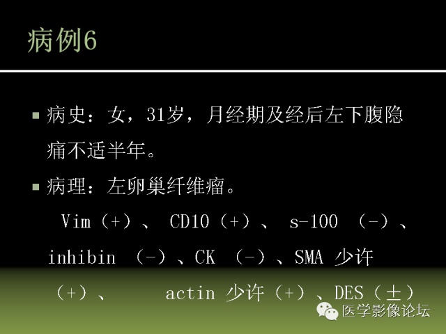 【PPT】卵巢颗粒细胞-间质细胞肿瘤的影像表现 【PPT】卵巢颗粒细胞-间质细胞肿瘤的影像表现
