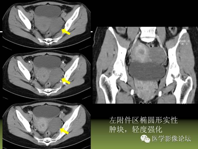 【PPT】卵巢颗粒细胞-间质细胞肿瘤的影像表现 【PPT】卵巢颗粒细胞-间质细胞肿瘤的影像表现