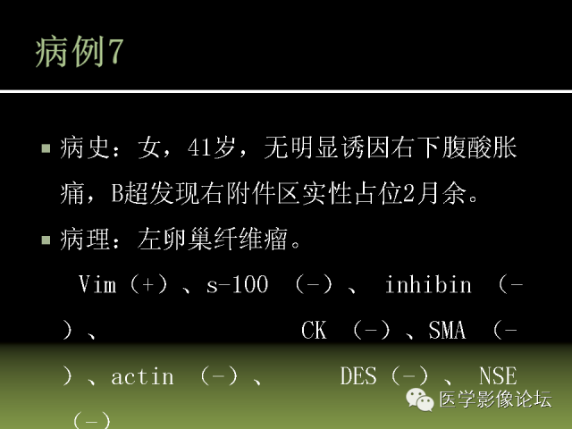 【PPT】卵巢颗粒细胞-间质细胞肿瘤的影像表现 【PPT】卵巢颗粒细胞-间质细胞肿瘤的影像表现