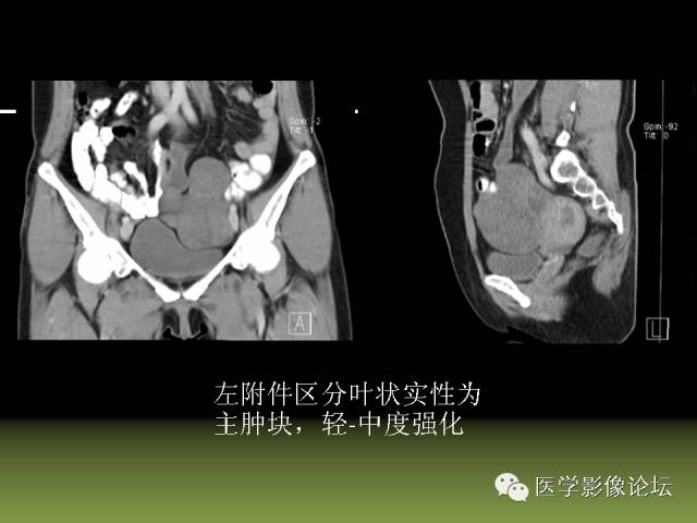 【PPT】卵巢颗粒细胞-间质细胞肿瘤的影像表现 【PPT】卵巢颗粒细胞-间质细胞肿瘤的影像表现