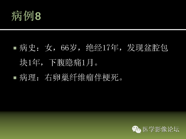 【PPT】卵巢颗粒细胞-间质细胞肿瘤的影像表现 【PPT】卵巢颗粒细胞-间质细胞肿瘤的影像表现