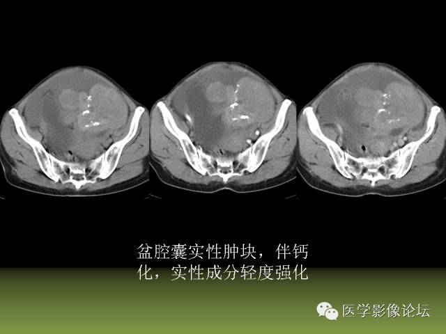 【PPT】卵巢颗粒细胞-间质细胞肿瘤的影像表现 【PPT】卵巢颗粒细胞-间质细胞肿瘤的影像表现