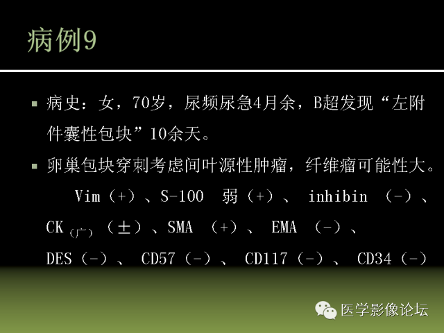 【PPT】卵巢颗粒细胞-间质细胞肿瘤的影像表现 【PPT】卵巢颗粒细胞-间质细胞肿瘤的影像表现