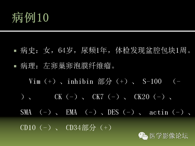 【PPT】卵巢颗粒细胞-间质细胞肿瘤的影像表现 【PPT】卵巢颗粒细胞-间质细胞肿瘤的影像表现