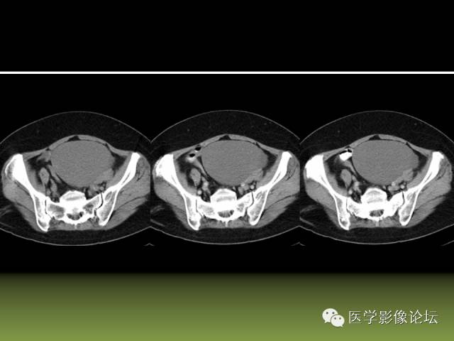 【PPT】卵巢颗粒细胞-间质细胞肿瘤的影像表现 【PPT】卵巢颗粒细胞-间质细胞肿瘤的影像表现
