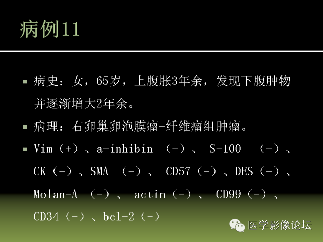 【PPT】卵巢颗粒细胞-间质细胞肿瘤的影像表现 【PPT】卵巢颗粒细胞-间质细胞肿瘤的影像表现