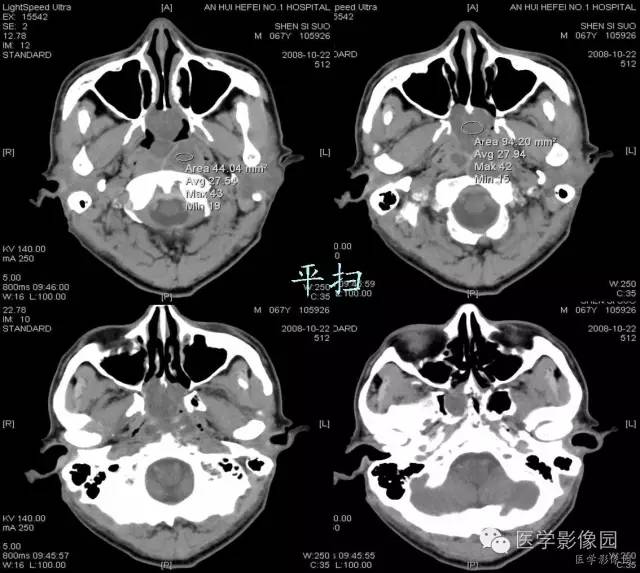 【病例】鼻咽部脊索瘤1例CT影像表现
