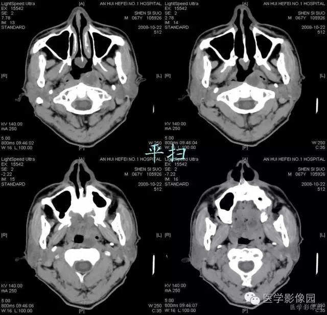 【病例】鼻咽部脊索瘤1例CT影像表现 【病例】鼻咽部脊索瘤1例CT影像表现