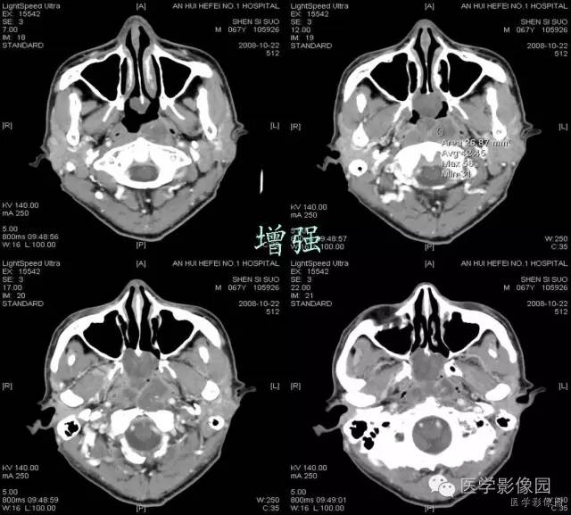 【病例】鼻咽部脊索瘤1例CT影像表现 【病例】鼻咽部脊索瘤1例CT影像表现