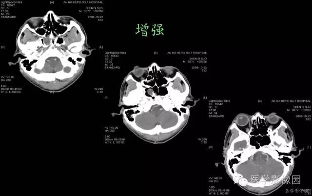 【病例】鼻咽部脊索瘤1例CT影像表现 【病例】鼻咽部脊索瘤1例CT影像表现