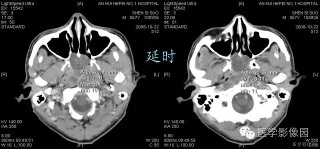 【病例】鼻咽部脊索瘤1例CT影像表现 【病例】鼻咽部脊索瘤1例CT影像表现