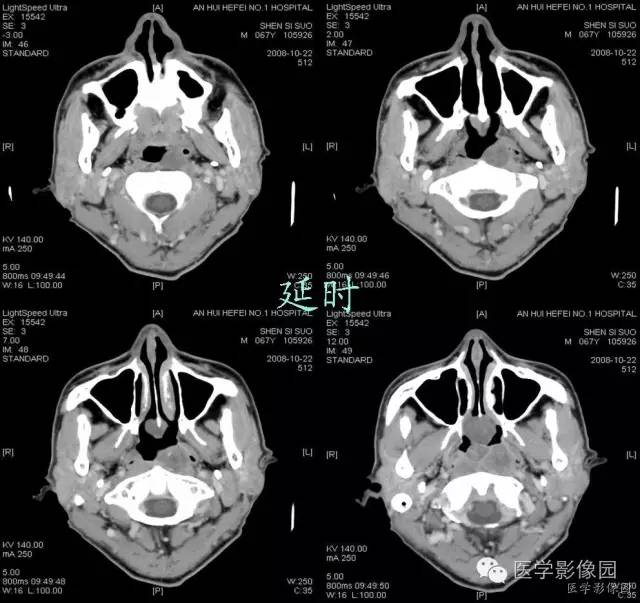 【病例】鼻咽部脊索瘤1例CT影像表现 【病例】鼻咽部脊索瘤1例CT影像表现
