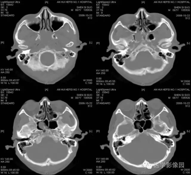 【病例】鼻咽部脊索瘤1例CT影像表现 【病例】鼻咽部脊索瘤1例CT影像表现