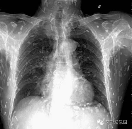 “囊虫病”图文精讲 “囊虫病”图文精讲